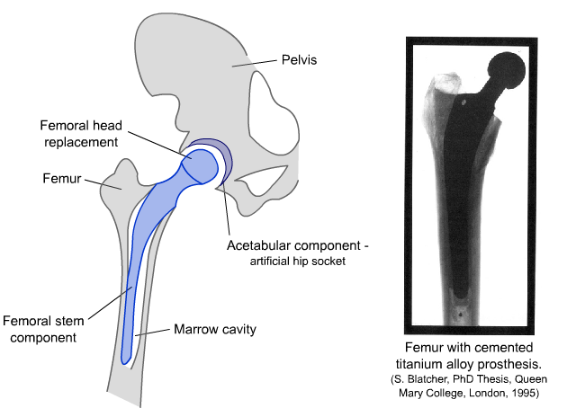 Diagram and radiograph of a hip replacement 